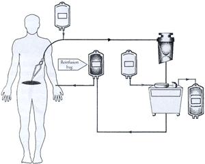 Diagram of intraoperative recovery of blood