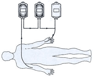 Diagram of acute normovolemic hemodilution