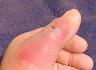 Brown Recluse Bite