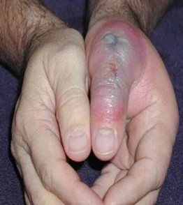 Spider Bites