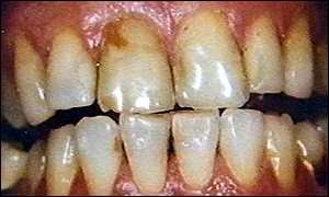 Unclean teeth