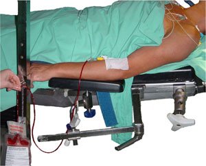 Normovolemic hemodilution before the start of surgery