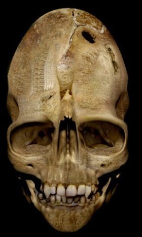 The Andover Vampire Skull - The Andover skull – experts say it’s real. (is either Nephilim/Giant or UFO alien, both are offspring of Fallen Angels and Human Women)