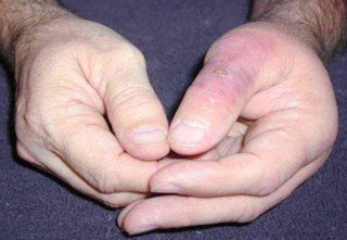 Brown Recluse Spider Bites