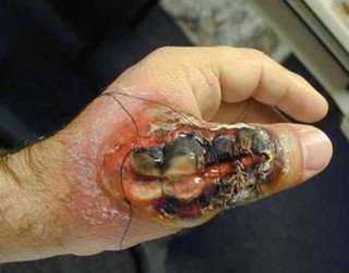 Brown Recluse Spider Bite Picture