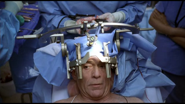 Awake Craniotomy General Information & How it works - medicalkidunya